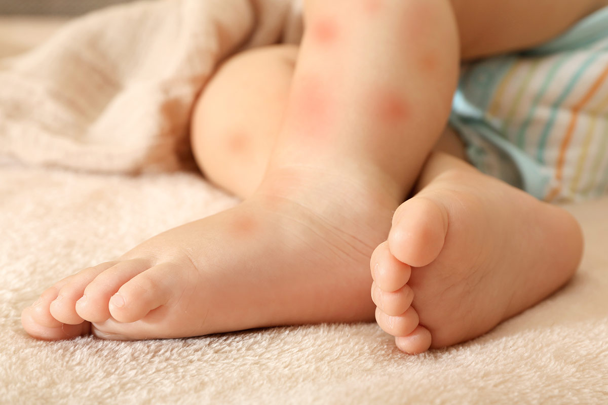 alergia-alimentaria-bebes