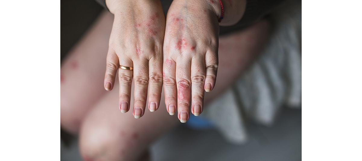 artritis psoriasica sintomas
