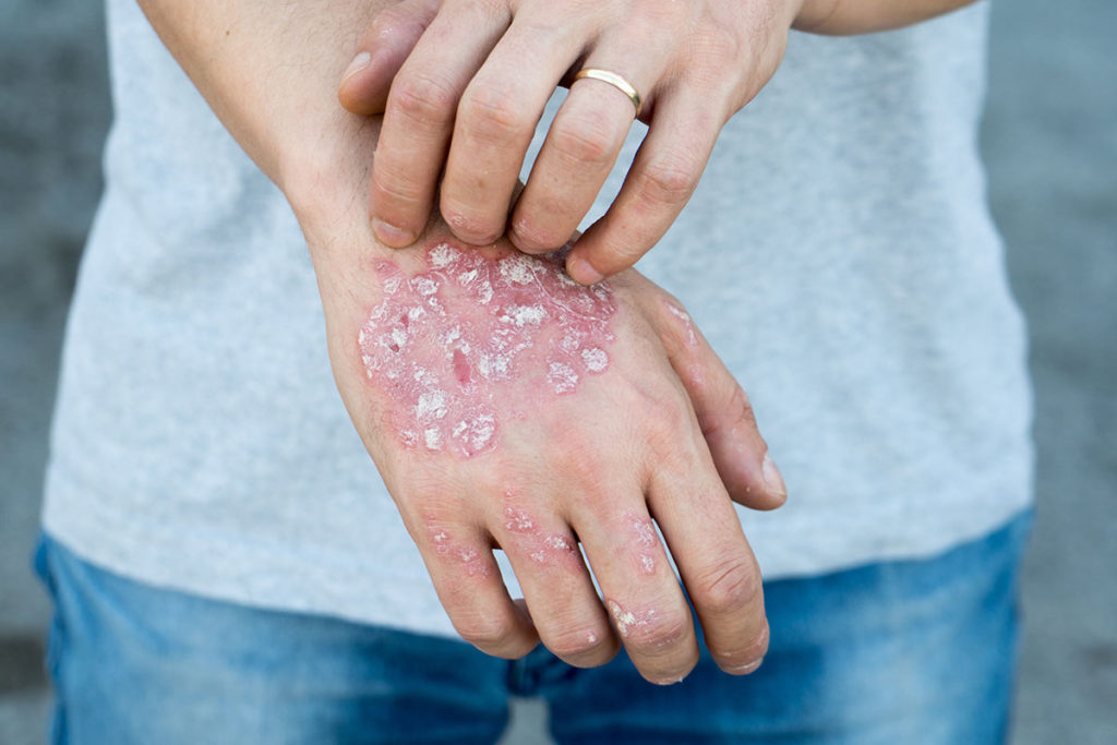 artritis-psoriasica
