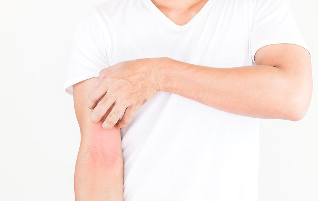 dermatitis-atopica