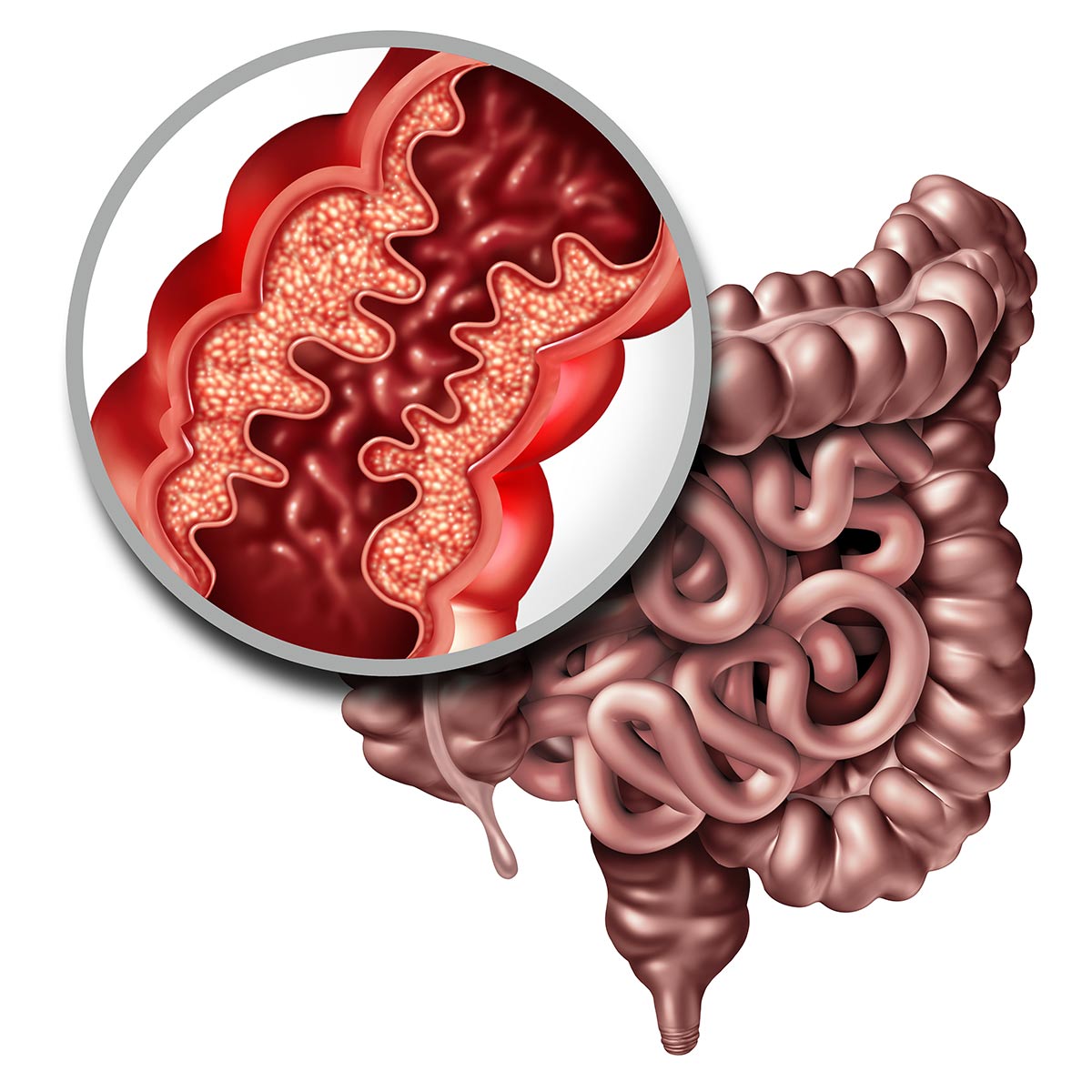 enfermedad-de-crohn-pdf