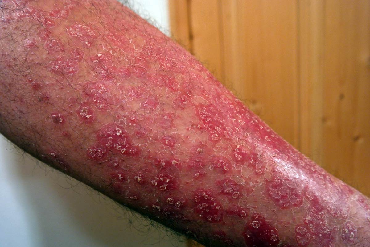 psoriasis-tipos