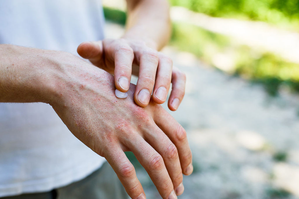 psoriasis-tratamiento