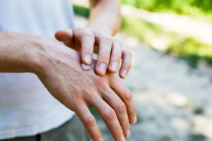 psoriasis-tratamiento