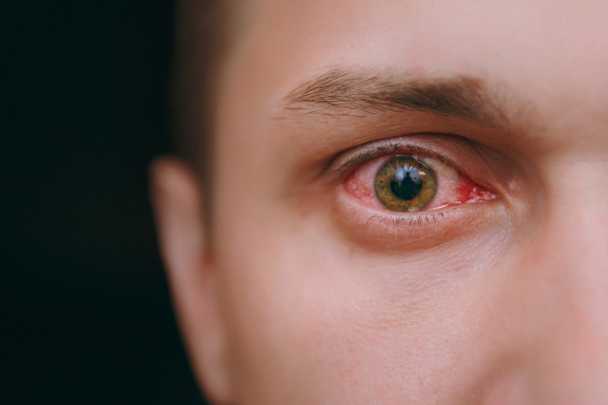 sindrome de behcet