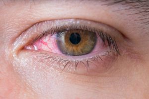 uveitis