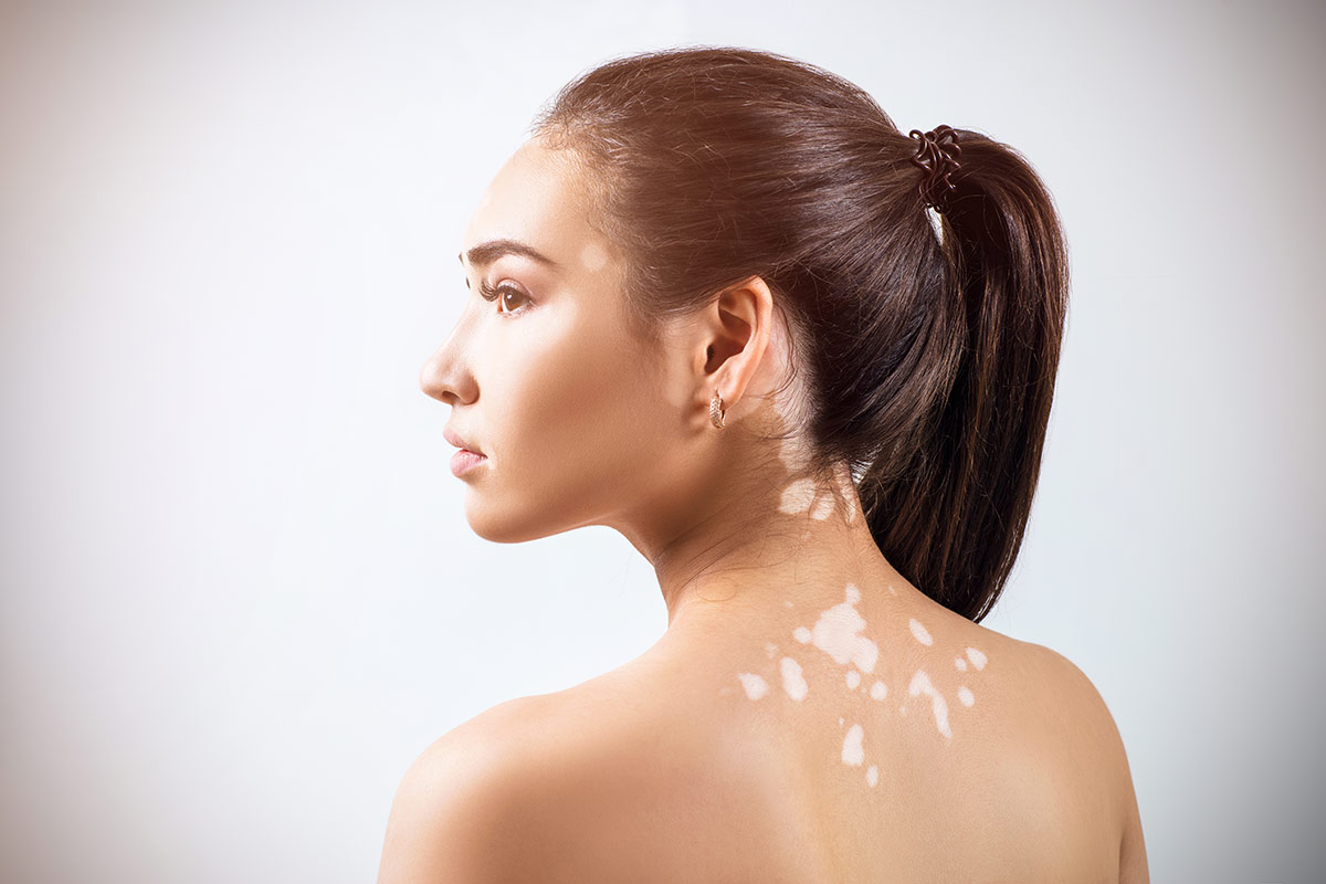 vitiligo tratamiento