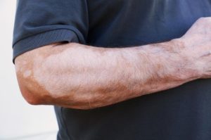vitiligo